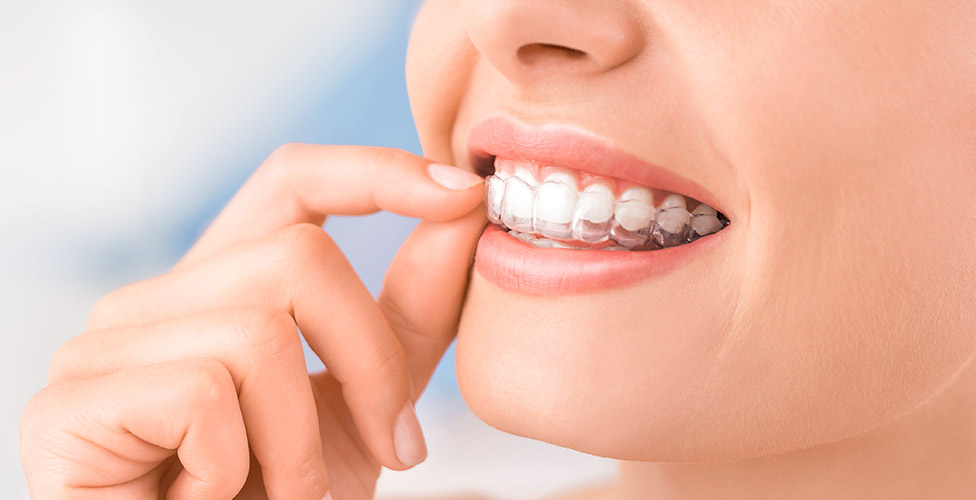 Patient inserting Invisalign aligner